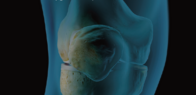 Knee Preservation Sympozium