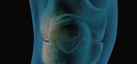 Knee Preservation Sympozium